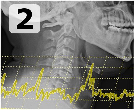 APPLICAZIONE DI sEMG BIOFEEDBACK PER IL TRATTAMENTO DELLA DISFAG